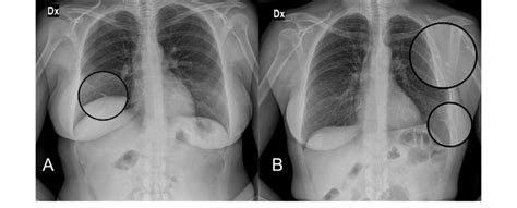 rfid chip breast implant|rfid implants before and after.